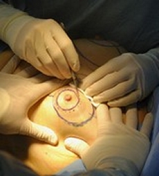 Szilkon implantátum