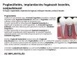 A fogbeültetés azonnali megoldás - http://fogaszatifogbeultetes.hu/